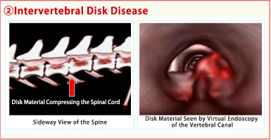 2.Intervertebral Disk Disease
