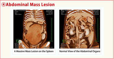 4.Abdominal Mass Lesion