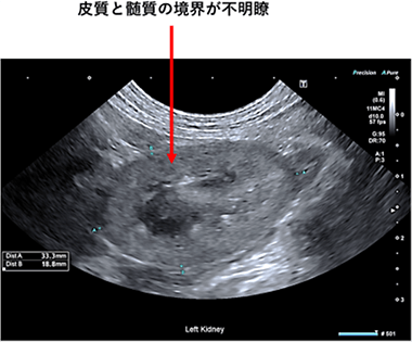 慢性腎臓病